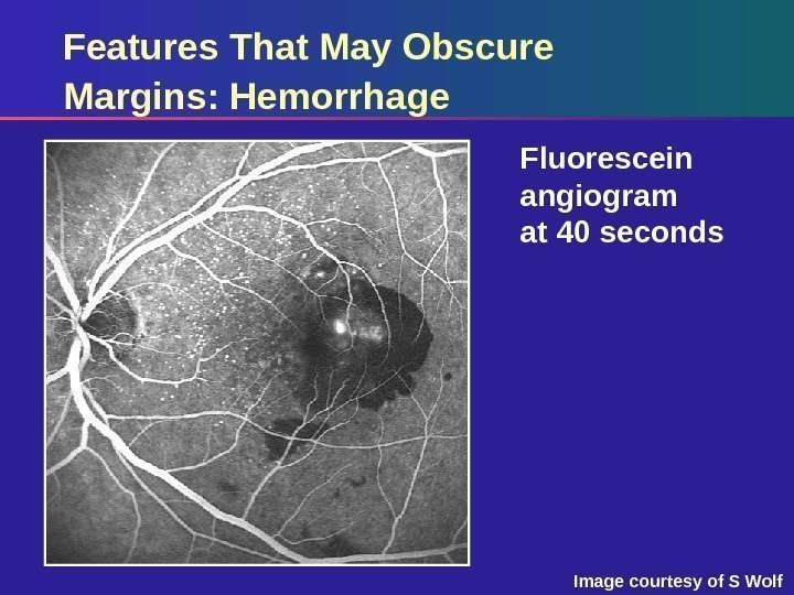 Features That May Obscure Margins: Hemorrhage Fluorescein angiogram at 40 seconds Image courtesy of