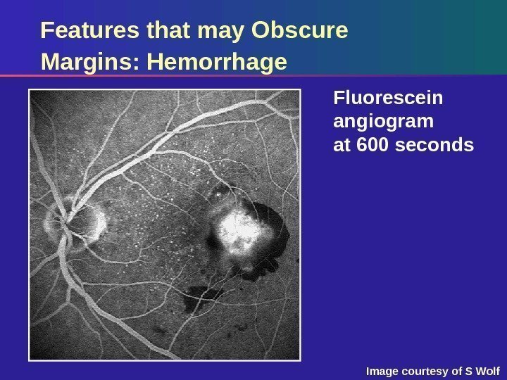 Features that may Obscure Margins: Hemorrhage Fluorescein angiogram at 600 seconds Image courtesy of