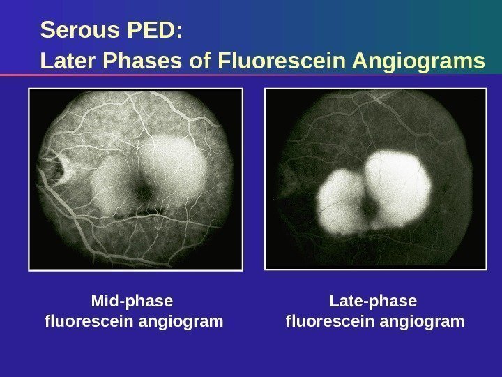 Serous PED:  Later Phases of Fluorescein Angiograms Late-phase fluorescein angiogram. Mid-phase fluorescein angiogram