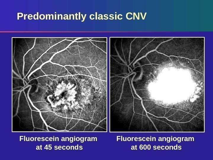Predominantly classic CNV Fluorescein angiogram at 600 seconds. Fluorescein angiogram at 45 seconds 