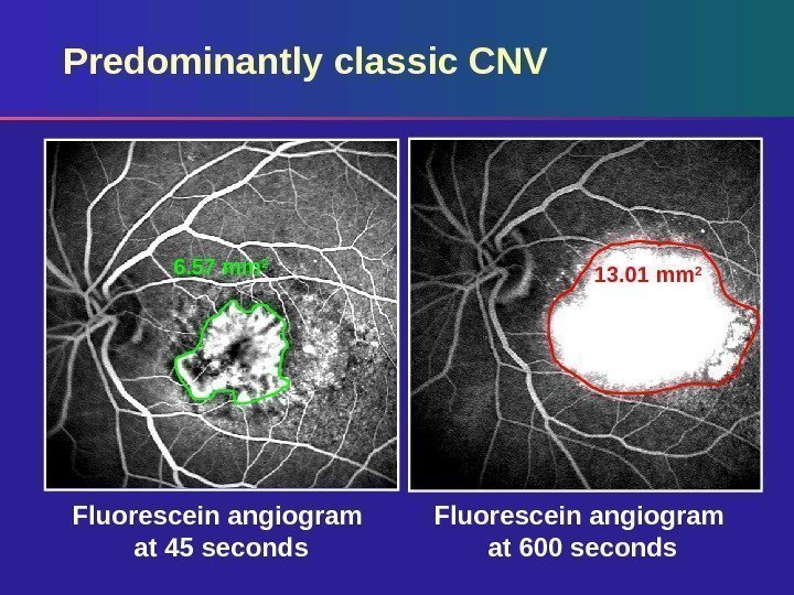 Fluorescein angiogram at 600 seconds. Fluorescein angiogram at 45 seconds. Predominantly classic CNV 6.