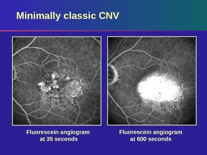 Minimally classic CNV Fluorescein angiogram at 600 seconds. Fluorescein angiogram at 35 seconds 