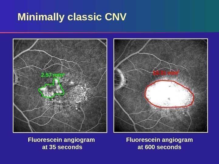 Fluorescein angiogram at 600 seconds. Fluorescein angiogram at 35 seconds. Minimally classic CNV 10.