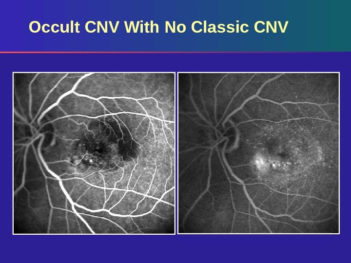 Occult CNV With No Classic CNV 