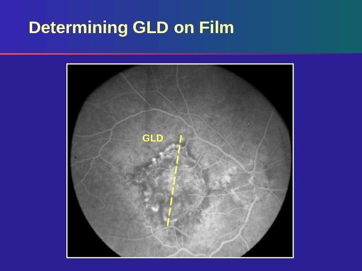 GLDDetermining GLD on Film 