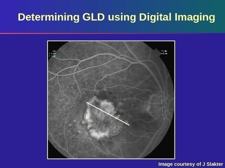 Determining GLD using Digital Imaging Image courtesy of J Slakter 