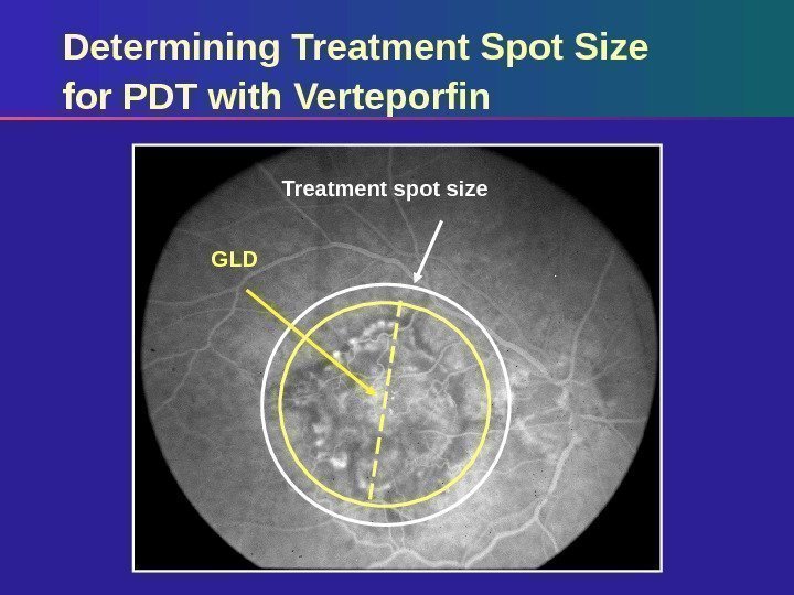 Treatment spot size GLDDetermining Treatment Spot Size for PDT with Verteporfin 