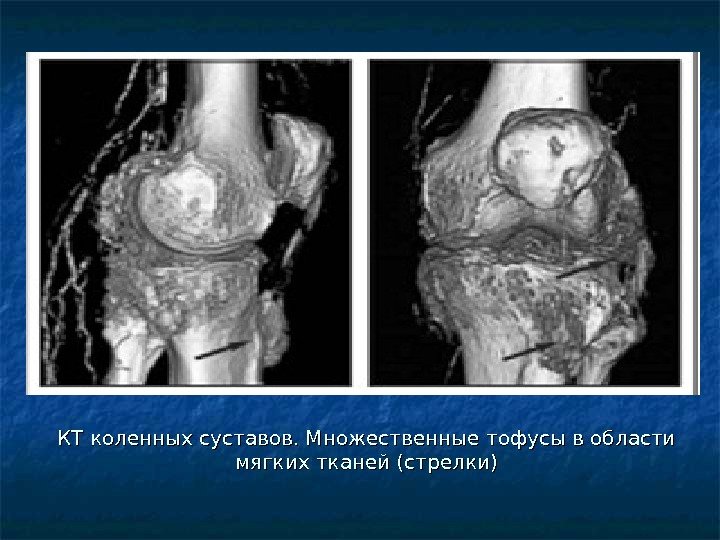 КТ коленных суставов. Множественные тофусы в области мягких тканей (стрелки) 