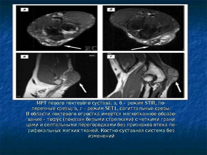 МРТ левого локтевого сустава. а, б – режим STIR, по- перечные срезы; в, г