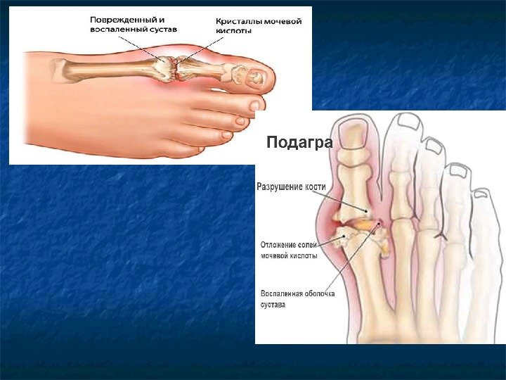 Презентации на тему подагра