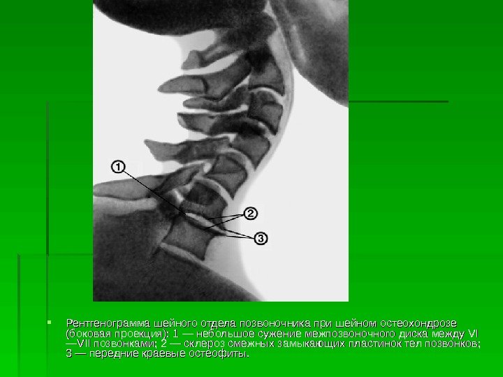  Рентгенограмма шейного отдела позвоночника при шейном остеохондрозе (боковая проекция): 1 — небольшое сужение