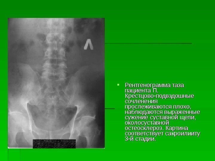  Рентгенограмма таза пациента П.  Крестцово-подвздошные сочленения прослеживаются плохо,  наблюдаются выраженные сужение
