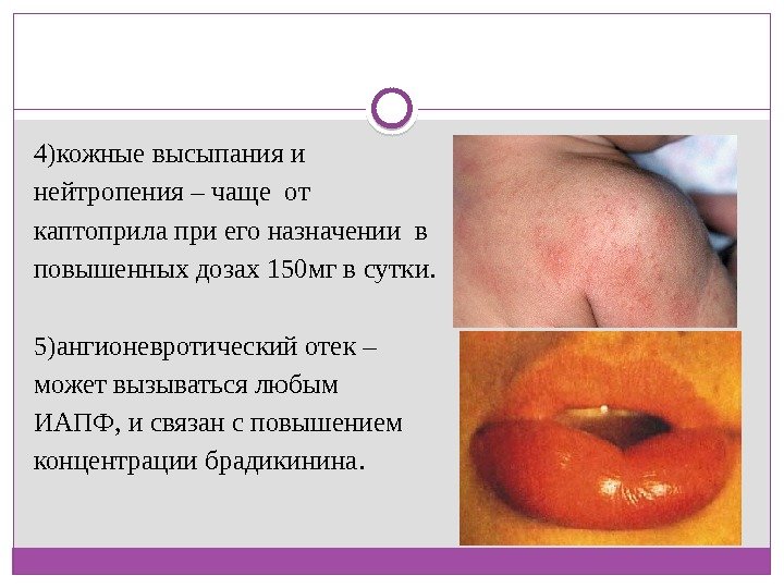 4)кожные высыпания и нейтропения – чаще от каптоприла при его назначении в повышенных дозах