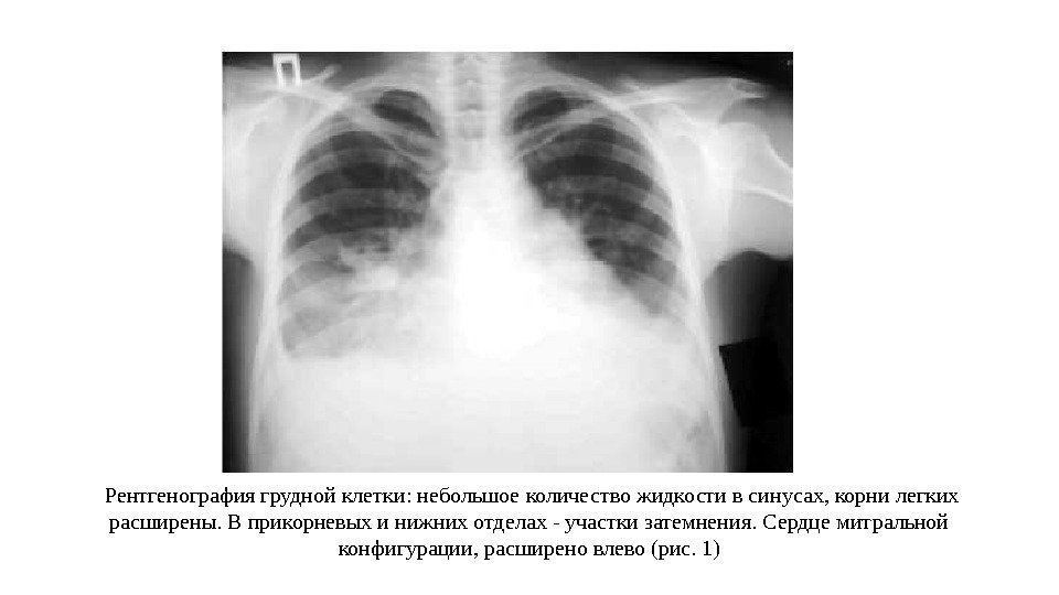 Рентгенография грудной клетки: небольшое количество жидкости в синусах, корни легких расширены. В прикорневых