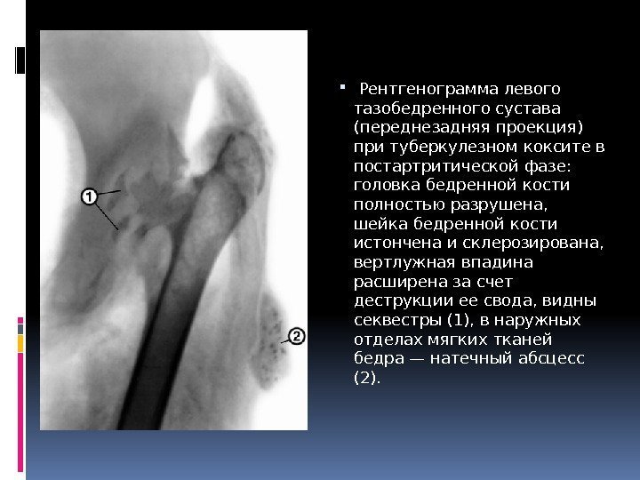   Рентгенограмма левого тазобедренного сустава (переднезадняя проекция) при туберкулезном коксите в постартритической фазе: