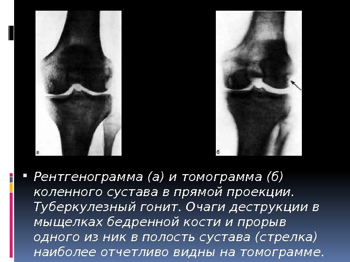  Рентгенограмма (а) и томограмма (б) коленного сустава в прямой проекции.  Туберкулезный гонит.