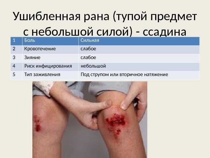 Ушибленная рана (тупой предмет с небольшой силой) - ссадина 1 Боль Сильная 2 Кровотечение