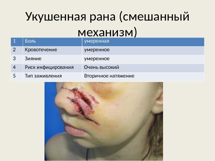 Укушенная рана (смешанный механизм) 1 Боль умеренная 2 Кровотечение умеренное 3 Зияние умеренное 4