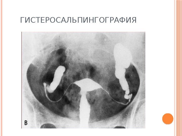 ГИСТЕРОСАЛЬПИНГОГРАФИЯ 