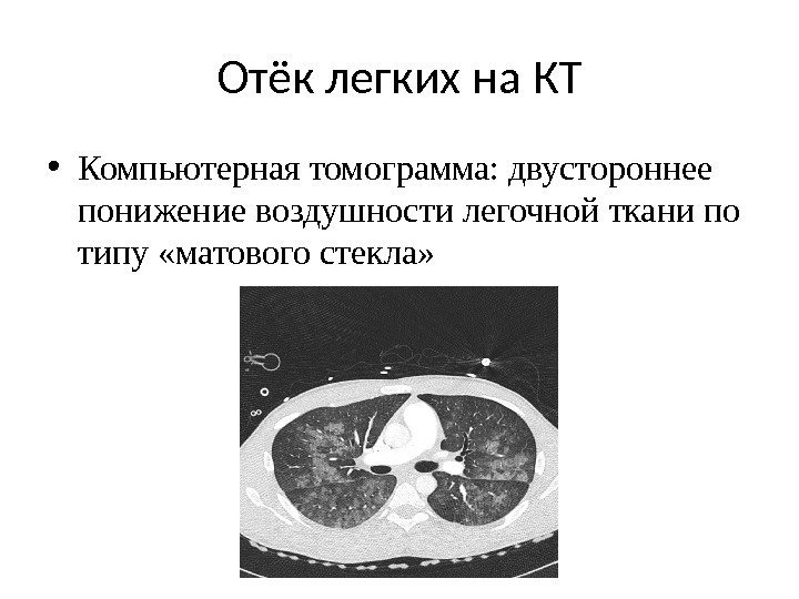 Лучевая диагностика в интенсивной терапии  Отёк легких