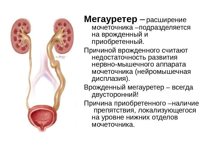 Почки извитой каналец мочеточники мочевой пузырь. Врожденное расширение мочеточника [врожденный мегалоуретер]. Нейромышечная дисплазия мочеточника. Нервно мышечная дисплазия мочеточника. Рефлюксирующий мегауретер.