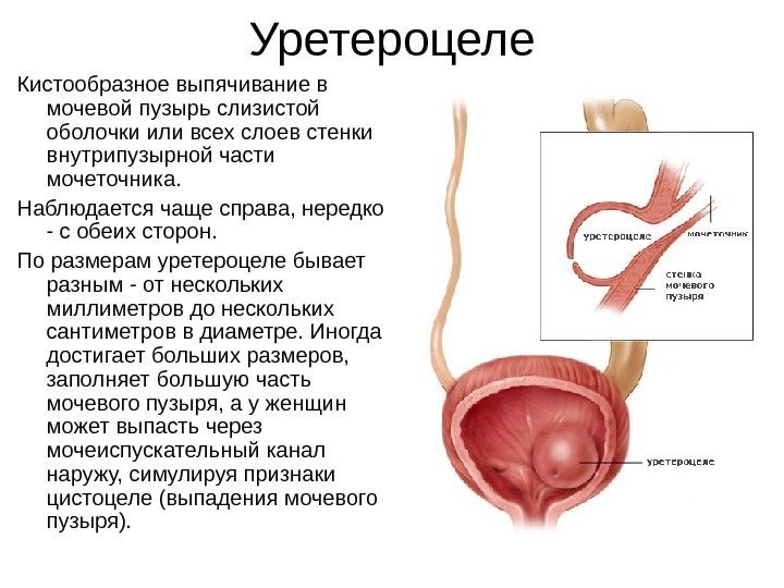 Уретероцеле Кистообразное выпячивание в мочевой пузырь слизистой оболочки или всех слоев стенки внутрипузырной части