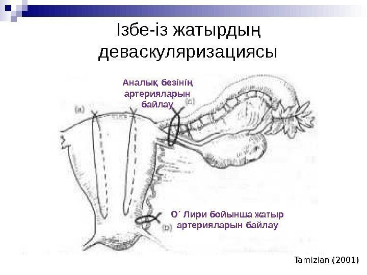 Ізбе - із жатырдың  деваскуляризациясы Tamizian (2001)О ´ Лири бойынша жатыр артерияларын байлау.