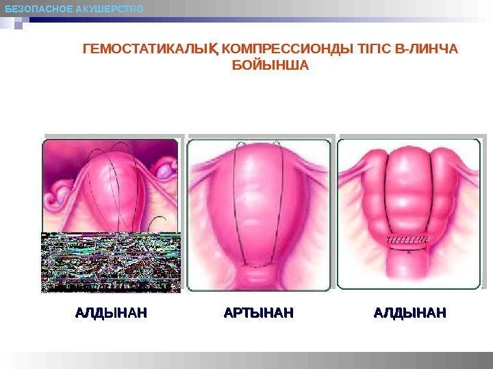 БЕЗОПАСНОЕ АКУШЕРСТВО ГЕМОСТАТИКАЛЫҚ  КОМПРЕССИОНДЫ ТІГІС В-ЛИНЧА БОЙЫНША АЛДЫНАНАЛДЫНАН АРТЫНАН  