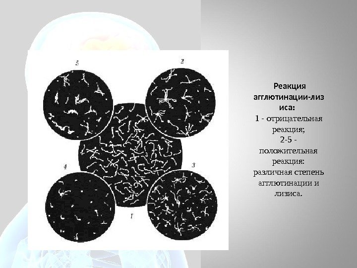  Реакция агглютинации-лиз иса: 1 - отрицательная реакция; 2 -5 - положительная реакция: 