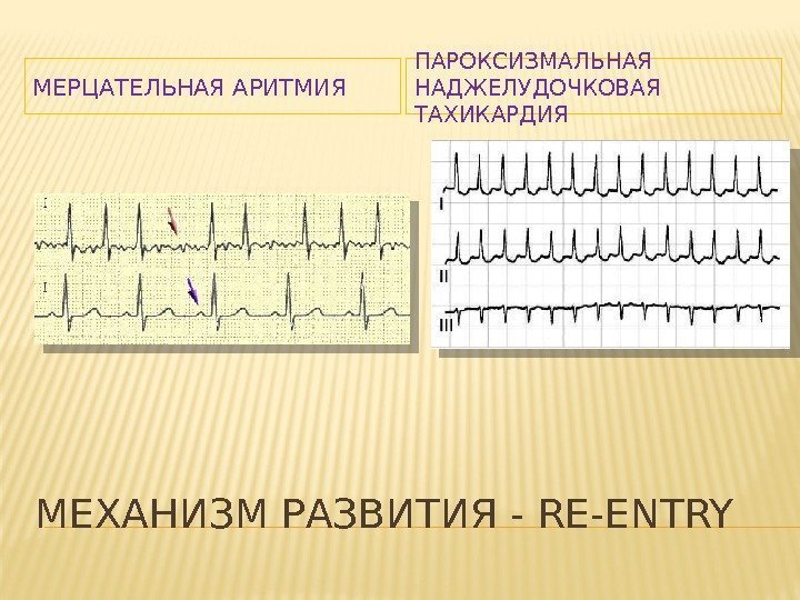 Пароксизмальная мерцательная аритмия карта вызова смп