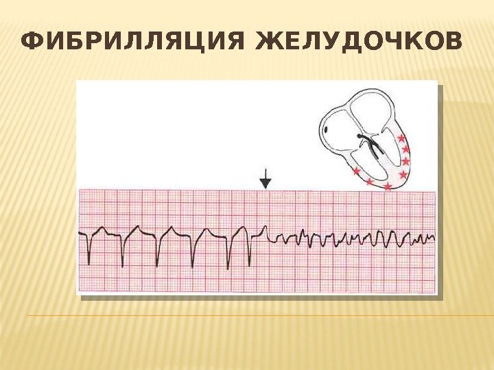 Как выглядит фибрилляция желудочков на мониторе