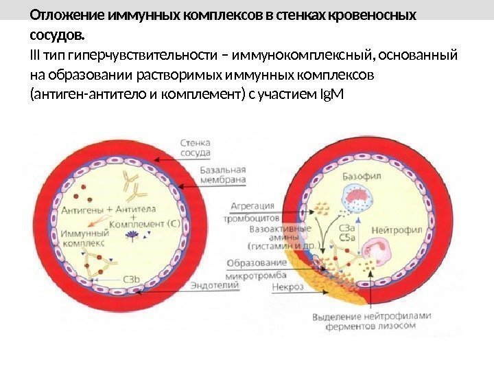 Отложение иммунных комплексов в стенках кровеносных сосудов. III тип гиперчувствительности – иммунокомплексный, основанный на