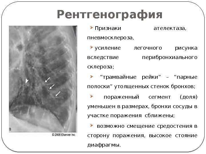 Пневмосклероз это простыми словами. Базальный пневмосклероз на рентгене. Постпневмонический пневмосклероз. Интерстициальный пневмосклероз.