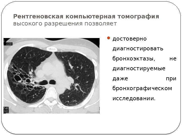 Рентгеновская компьютерная томография  высокого разрешения позволяет достоверно диагностировать бронхоэктазы,  не диагностируемые даже