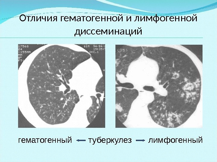 Отличия гематогенной и лимфогенной диссеминаций гематогенный  туберкулез  лимфогенный 