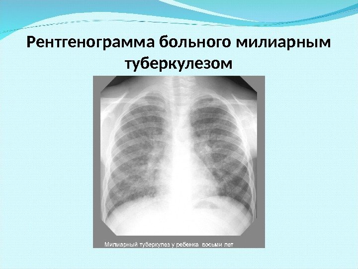 Рентгенограмма больного милиарным туберкулезом 