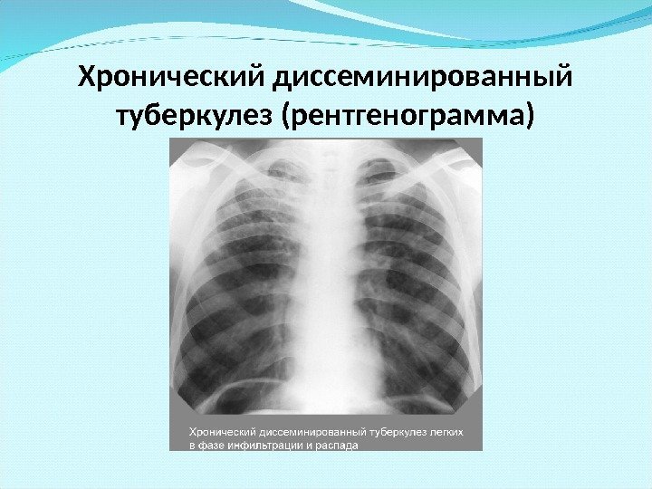 Хронический диссеминированный туберкулез (рентгенограмма) 