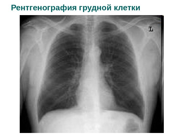 Рентгенография грудной клетки 