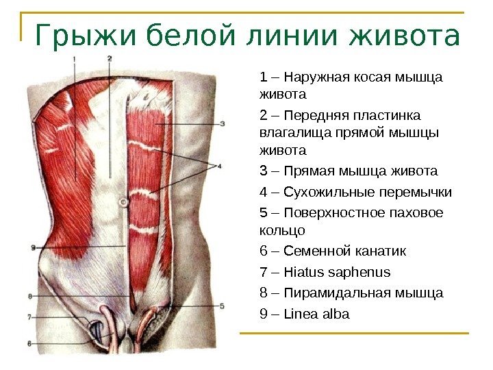 Грыжи белой линии живота 1 – Наружная косая мышца живота 2 – Передняя пластинка