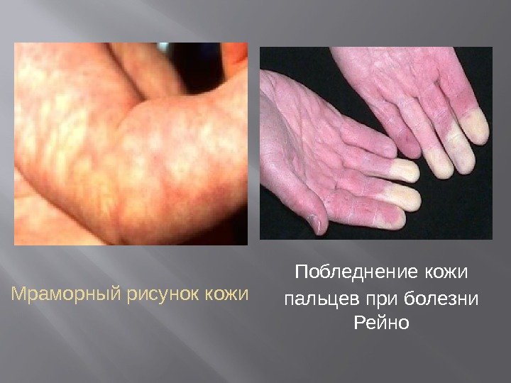 Мраморный рисунок кожи Побледнение кожи пальцев при болезни  Рейно 