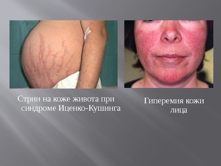 Стрии на коже живота при синдроме Иценко-Кушинга Гиперемия кожи лица 