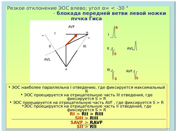   Анализ ЭКГРезкое отклонение ЭОС влево; угол α =   - 30