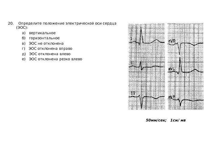   20. Определите положение электрической оси сердца (ЭОС):    а) 