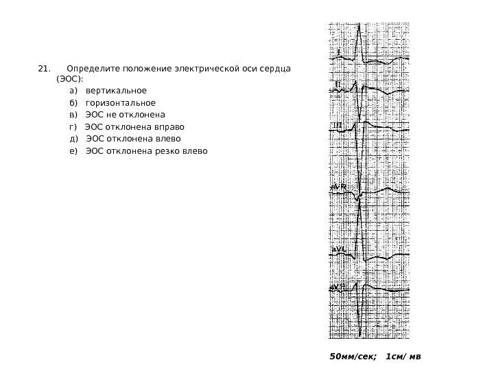   21.  Определите положение электрической оси сердца (ЭОС):    а)