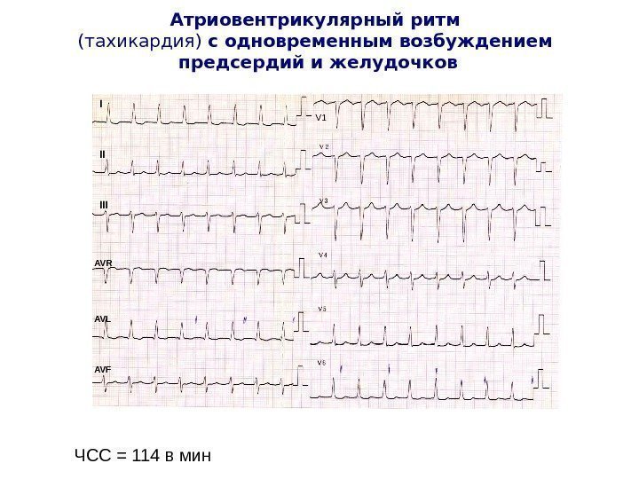   Атриовентрикулярный ритм (тахикардия) с одновременным возбуждением предсердий и желудочков ЧСС = 114