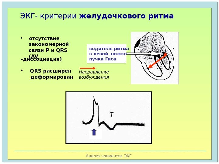   Анализ элементов ЭКГЭКГ- критерии желудочкового ритма водитель ритма в левой ножке пучка