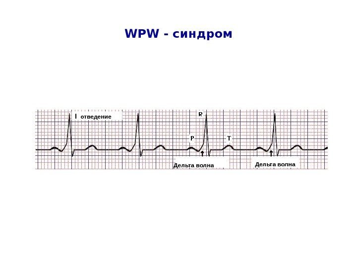  WPW - синдром I  отведение Дельта волна 