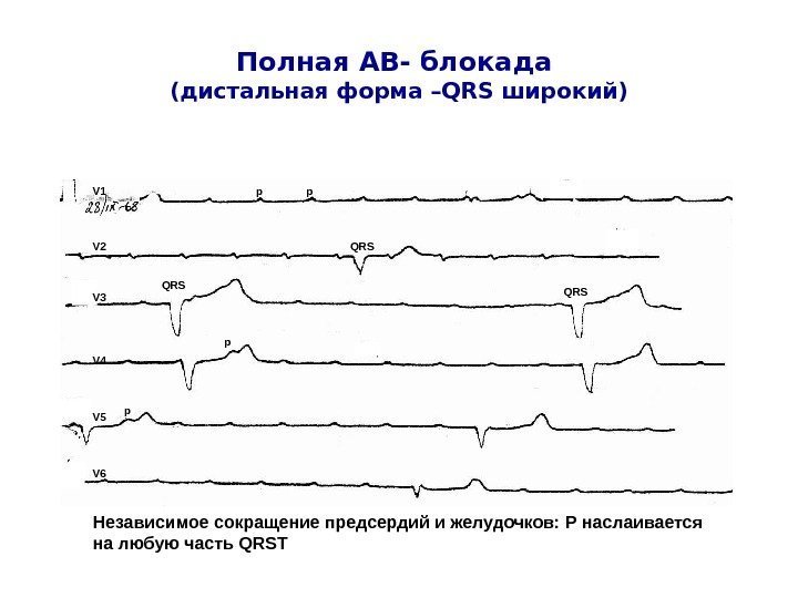   Полная АВ- блокада (дистальная форма – QRS широкий) V 1 V 2