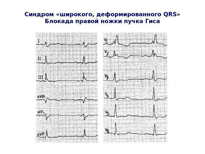   Синдром «широкого, деформированного QRS » Блокада правой ножки пучка Гиса 