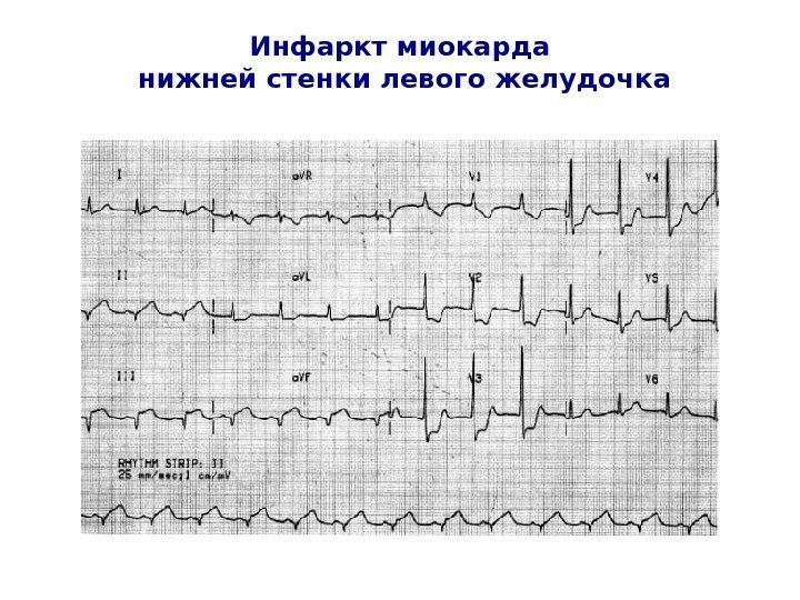   Инфаркт миокарда нижней стенки левого желудочка 